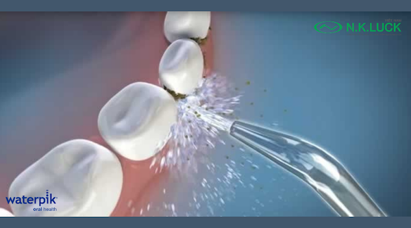 Máy tăm nước Waterpik hoàn toàn có thể loại bỏ mảng bám cứng đầu trên răng