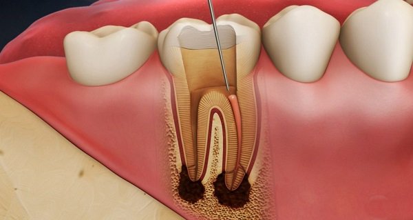mẹo vặt chữa hôi miệng