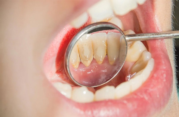 cách lấy cao răng tại nhà