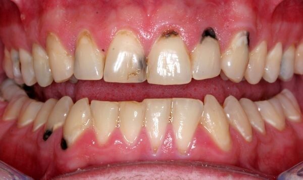 Răng bị sâu làm mất đi vẻ đẹp thẩm mỹ