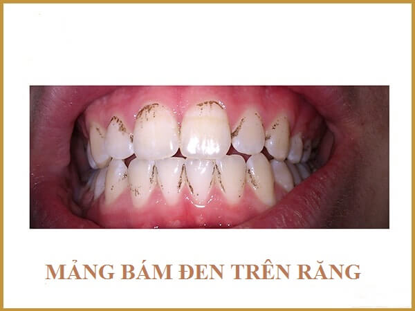 Mảng bám đen trên chân răng|Hút thuốc là một trong những nguyên nhân gây mảng bám đen trên răng|Cách làm sạch mảng bám trên răng bằng nguyên liệu tự nhiên|Cách dùng chỉ nha khoa để làm sạch
