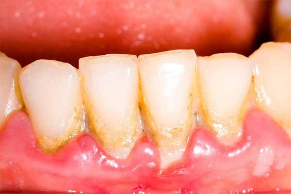 vệ sinh răng miệng đúng cách