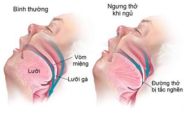 dụng cụ chống ngáy