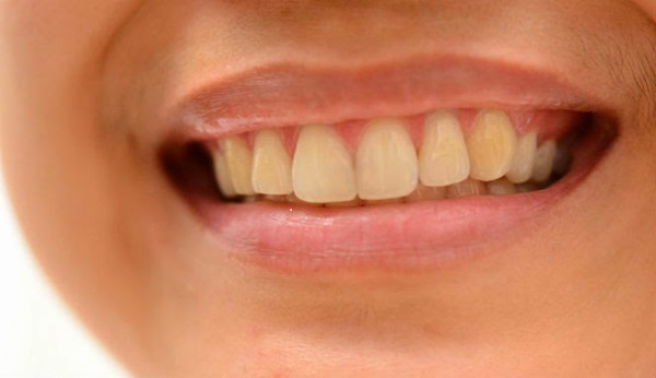 Nguyên nhân dẫn đến tình trạng bị ố vàng răng