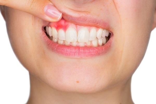 Biểu hiện mọc răng khôn nướu sưng đỏ