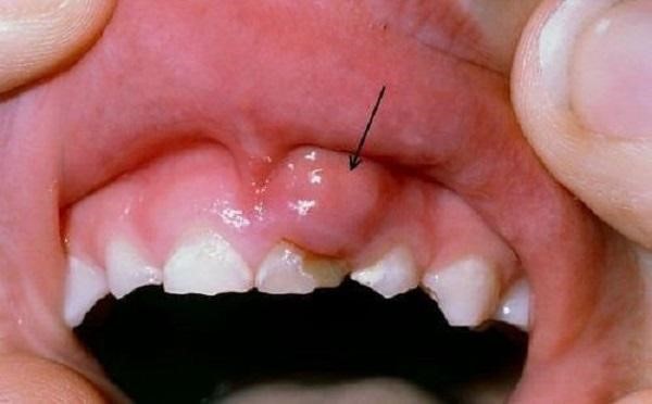 Tình trạng bị viêm lợi