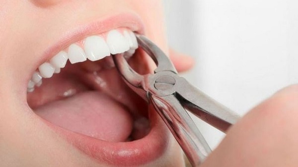 ||||cách cầm máu khi nhổ răng|cách cầm máu chân răng tại nhà|
