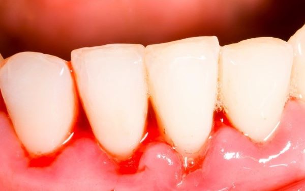 |đau răng nên kiêng ăn gì|chảy máu chân răng là bệnh gì|chảy máu răng là bệnh gì|chảy máu chân răng là thiếu chất gì|bị chảy máu chân răng là bệnh gì|hay chảy máu chân răng là bệnh gì|nguyên nhân gây chảy máu chân răng|chảy máu chân răng là bệnh gì|chảy máu răng là bệnh gì|chảy máu chân răng là thiếu chất gì|bị chảy máu chân răng là bệnh gì|hay chảy máu chân răng là bệnh gì|nguyên nhân gây chảy máu chân răng