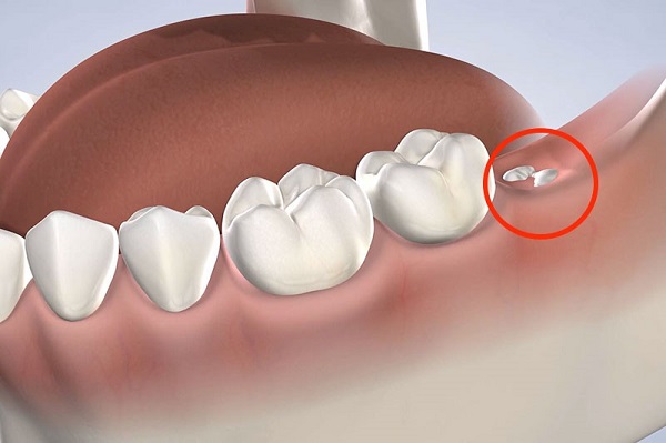 |dấu hiệu răng khôn mọc lệch|dấu hiệu răng khôn mọc lệch|dấu hiệu răng khôn mọc lệch|dấu hiệu răng khôn mọc lệch|||