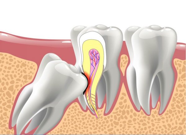Dấu hiệu răng khôn mọc lệch