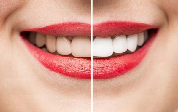 tẩy trắng răng có hại không