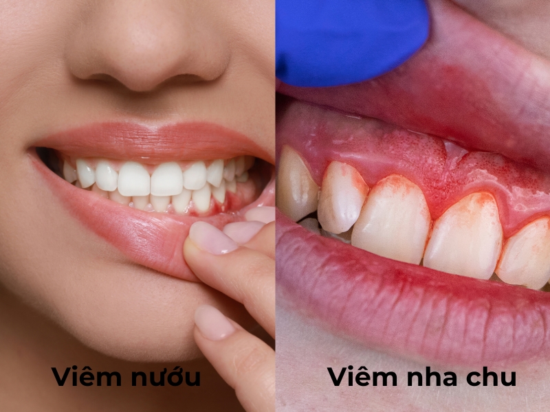 Phân biệt giữa viêm nướu và viêm nha chu