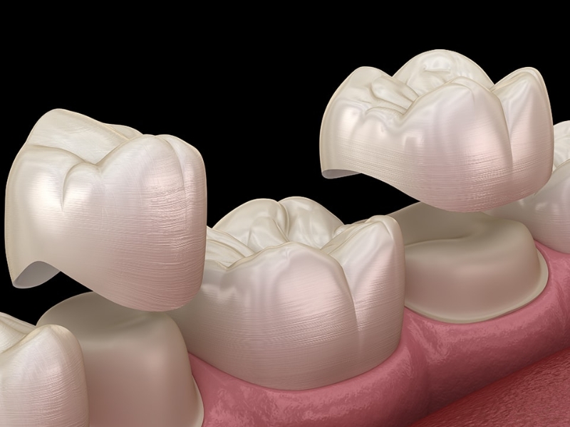 Phương pháp bọc sứ khi răng bị vỡ, mòn lớn