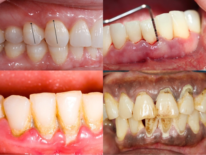Các giai đoạn của bệnh viêm nha chu