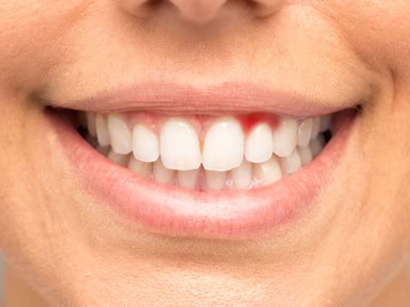 Giải đáp thắc mắc viêm nướu ở răng có nguy hiểm không