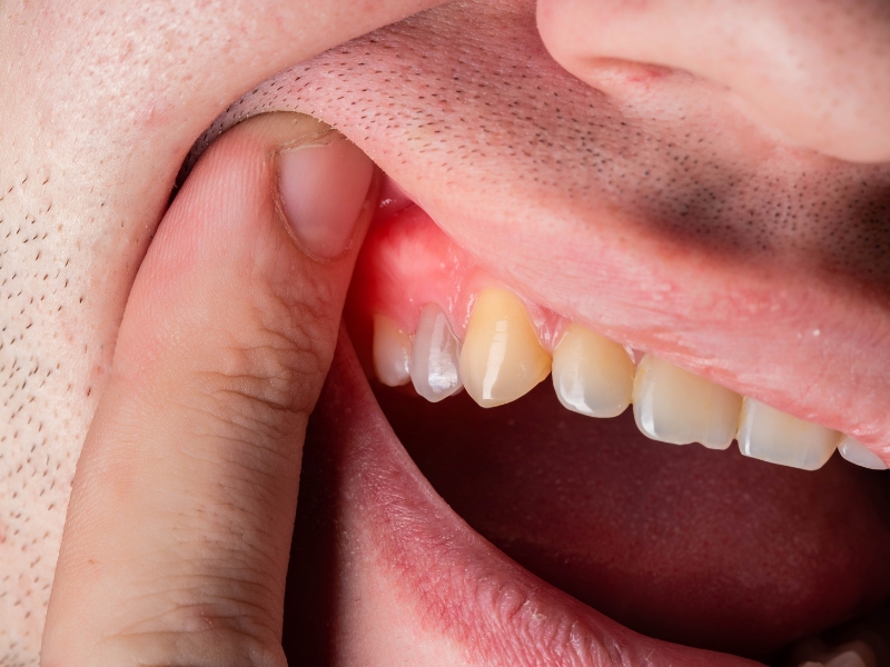 Tình trạng tích tụ mủ trong mô quanh răng do nhiễm trùng