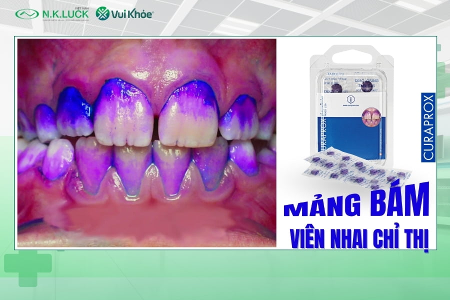 Viên nhai chỉ thị mảng bám thumbnail