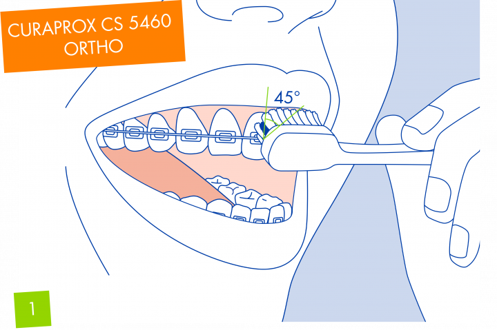 Bắt đầu bằng cách làm sạch đường viền nướu và vùng trên của răng phía trên niềng bằng các chuyển động tròn nhỏ, nhẹ nhàng. Đặt bàn chải ở một góc khoảng 45 độ hướng về phía đường viền nướu, sao cho một nửa nằm trên răng, một nửa nằm trên nướu.