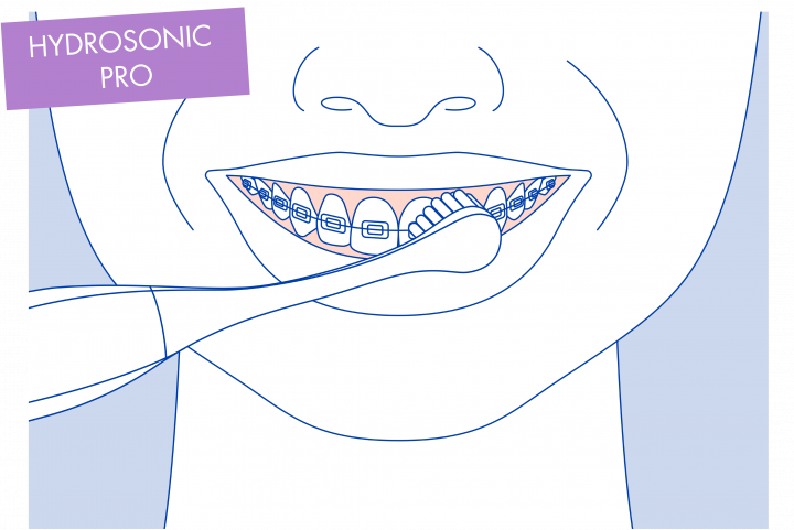 Để chải với Hydrosonic pro, chọn một trong các mức làm sạch phù hợp với tình trạng răng và nghiêng nhẹ đầu bàn chải về phía nướu. Di chuyển từ từ, từ răng này sang răng khác theo chuyển động tròn qua lại, gần như không sử dụng áp lực. Tiếp tục làm sạch tất cả các bề mặt bên ngoài của răng và niềng răng.