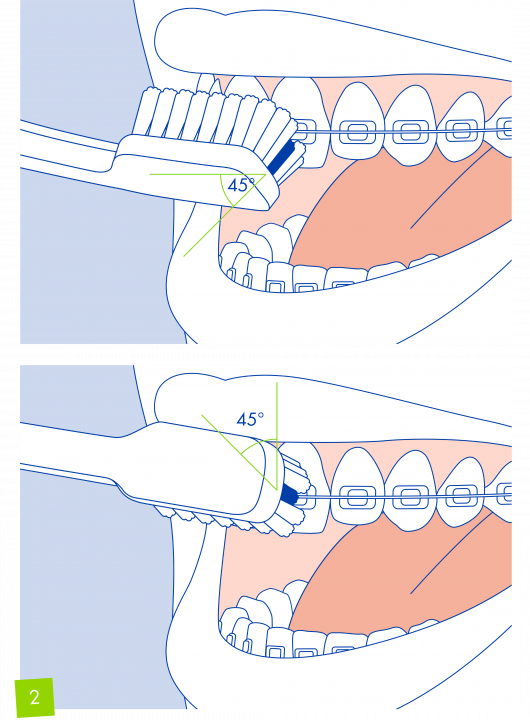 Tiếp theo, làm sạch trước phần trên rồi đến phần dưới của các mắc cài. Di chuyển bàn chải dọc theo răng và mắc cài, đặt bàn chải ở góc 45 độ hướng về các cạnh của mắc cài, và nhớ tránh các chuyển động ngang.