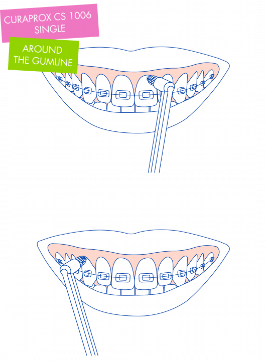 Vệ sinh đường viền nướu