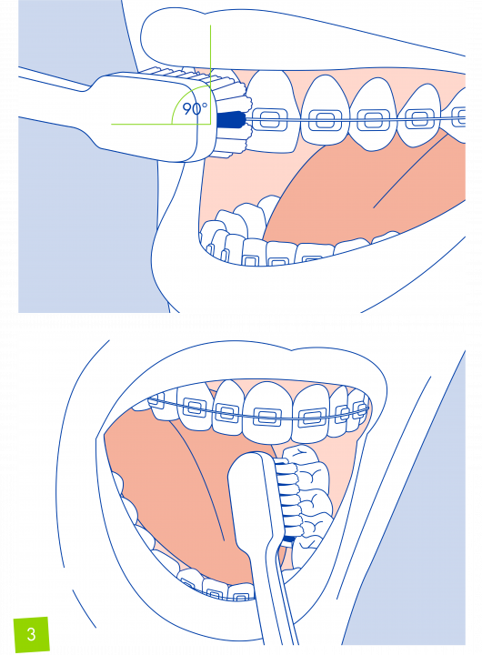 làm sạch toàn bộ khu vực ở giữa răng
